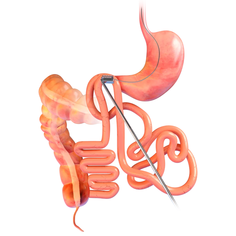 Two parts of the gut held together by the MagDI magnets